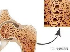 世界骨質(zhì)疏松日 | 慢病人群要警惕骨質(zhì)疏松這個“隱形殺手”
